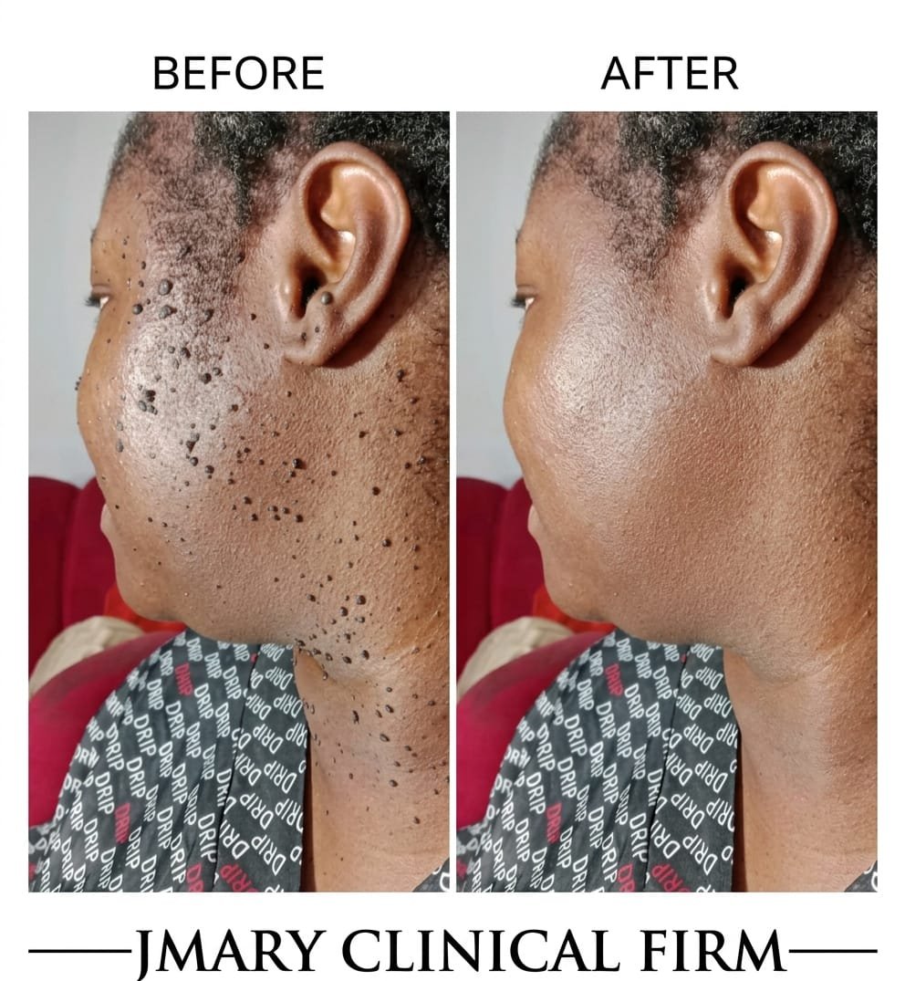 Mole & Skin Tag Removal