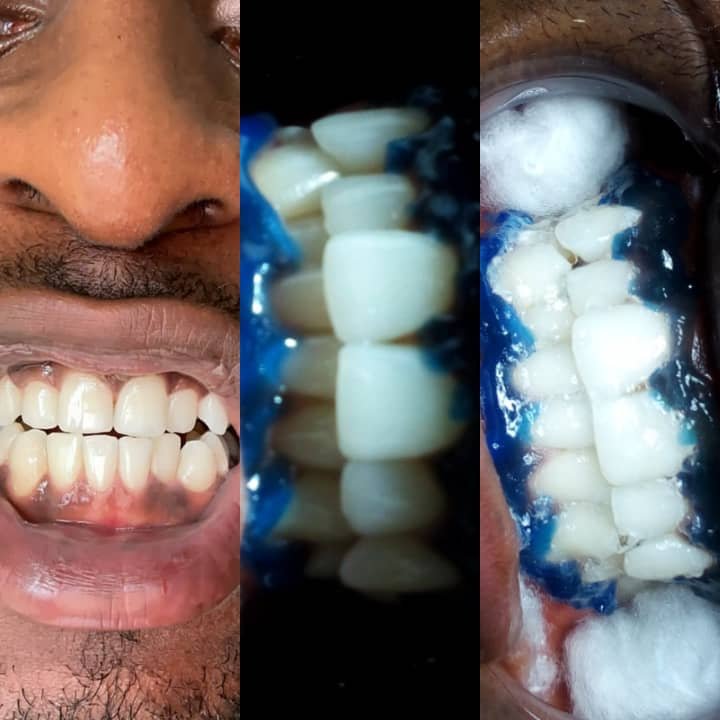 Tooth Scaling, Gem & Whitening